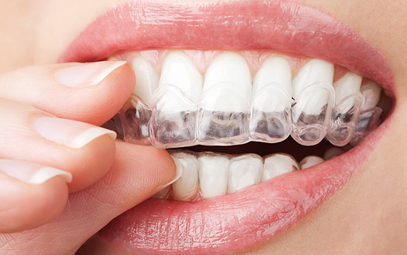 Invisalign